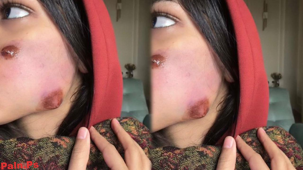 إصابة غناتي القحطاني بدمامل في وجهها